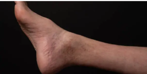 pain-free varicose vein treatment
